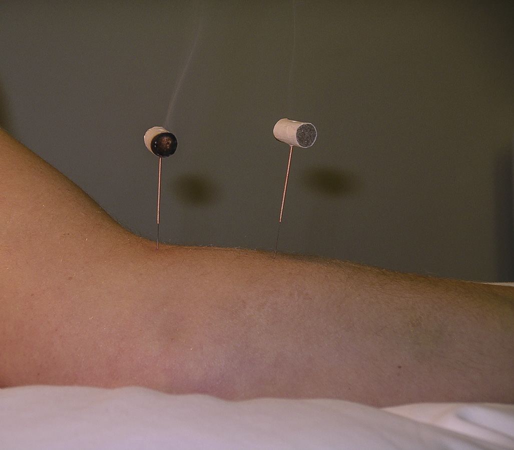 Moxabustion with Acupuncture